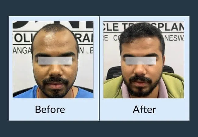 NFT Hair Transplant Before - After Images