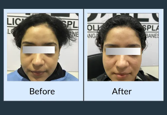Female hair restoration outcome before and after treatment