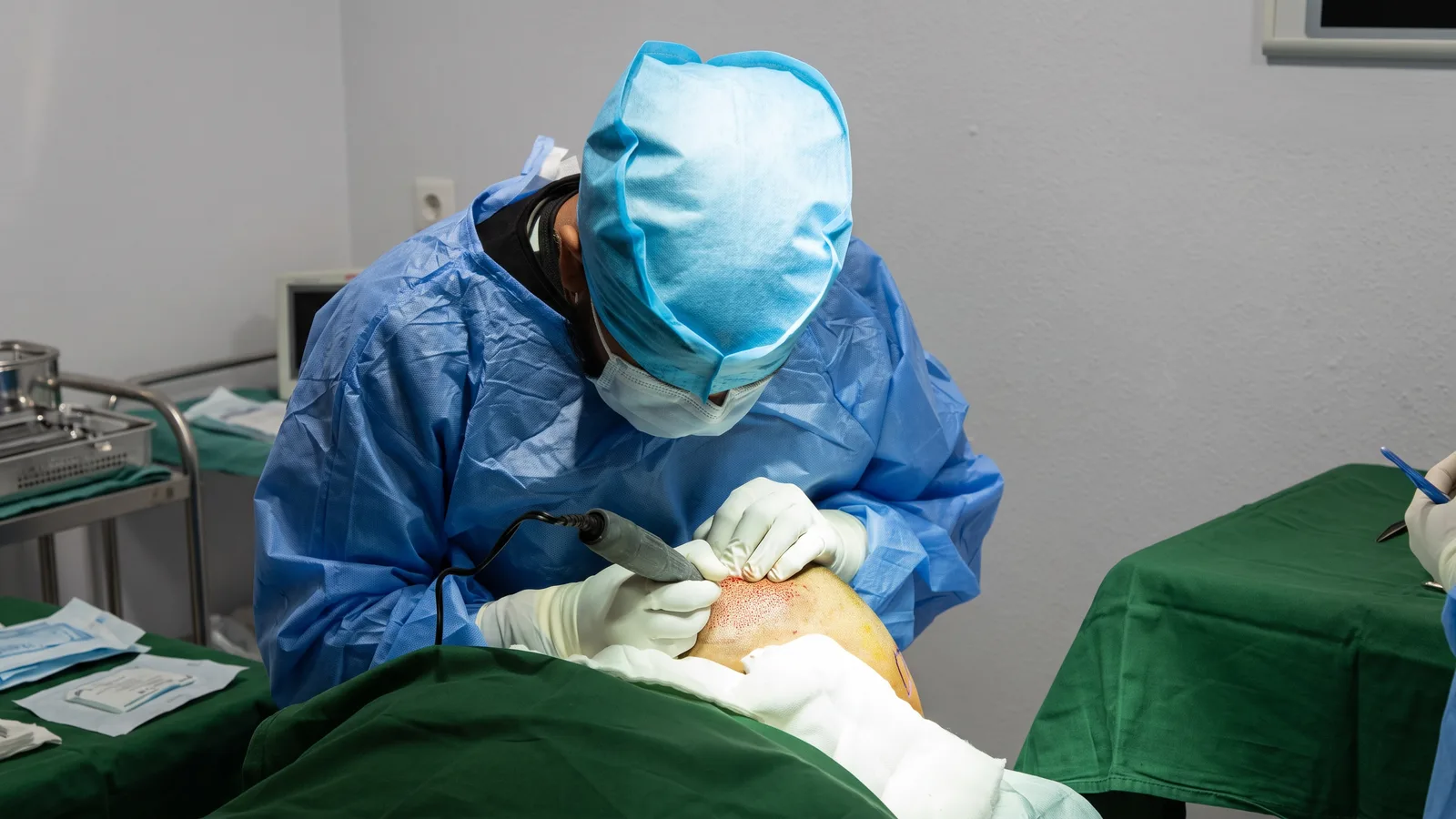 A surgeon performing a corrective hair transplant procedure on a patient’s frontal scalp.