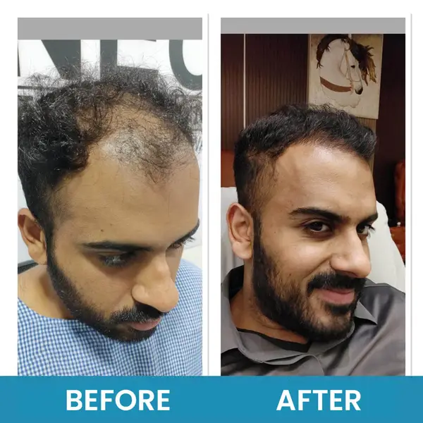 Exosome therapy before and after, profile view: thinning through the temple and front with the scalp showing, then noticeably fuller hair.