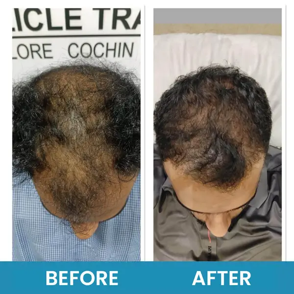 Exosome therapy before and after seen from above: diffuse thinning across the crown, then denser hair over the same area.