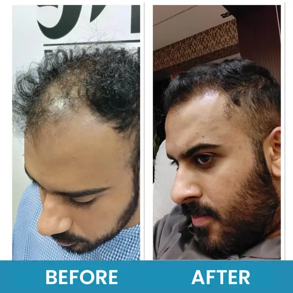 Exosome therapy before and after, profile view: a receded temple and sparse frontal hair, then improved density along the hairline.