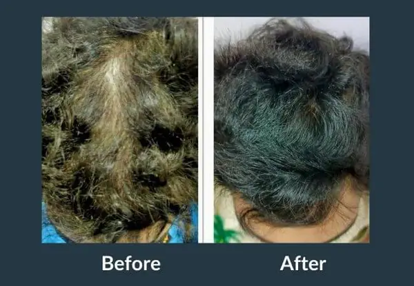 GFC therapy before and after: distinct bare patches through the hair, then regrowth filling those patches in.
