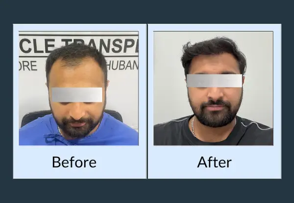 Hair transplant before and after: diffuse thinning through the frontal third, then thick dark hair covering the same area.