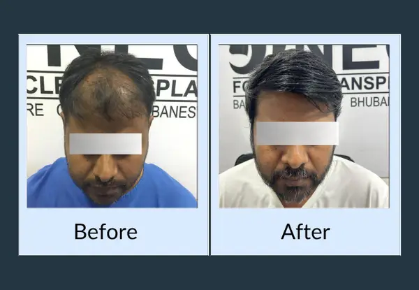 Hair transplant before and after: a bare frontal scalp with hair remaining only at the sides, then a full restored hairline.