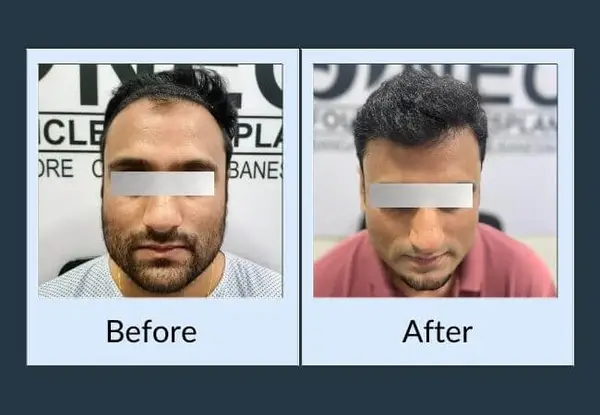 Hair transplant before and after: a high, receded hairline, then a lowered hairline with dense dark hair behind it.