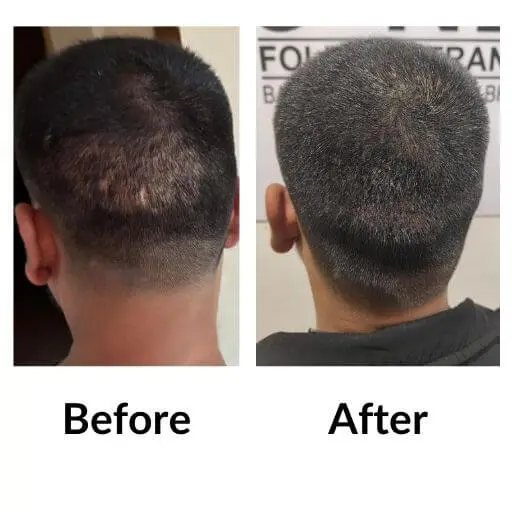 Scalp micropigmentation before and after, back of the head: patchy coverage through closely cropped hair, then a uniform hairline and even shading.