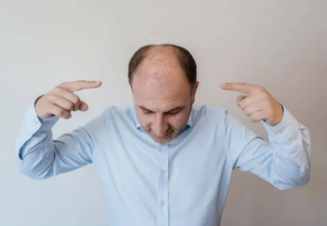 A man looking down and pointing at thinning hair across his crown.