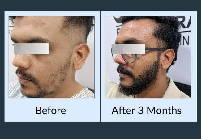 Before and after a beard transplant at Neo Follicle.