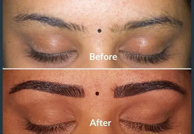 Before and after eyebrow restoration at Neo Follicle.