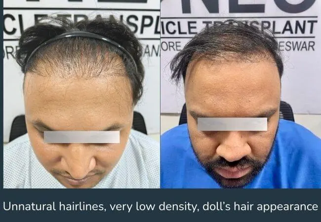 An unnatural hairline from an earlier transplant, assessed before repair.