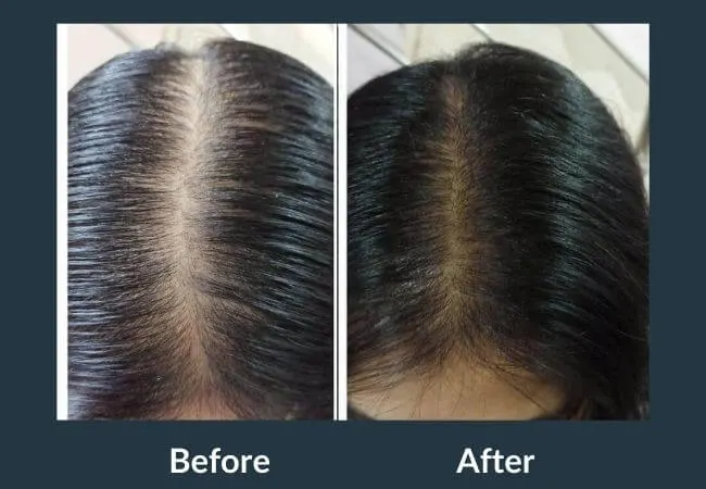 Before and after GFC hair therapy at Neo Follicle.