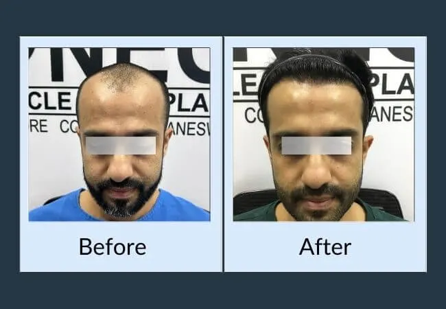 Before and after a hair transplant for a receding hairline.