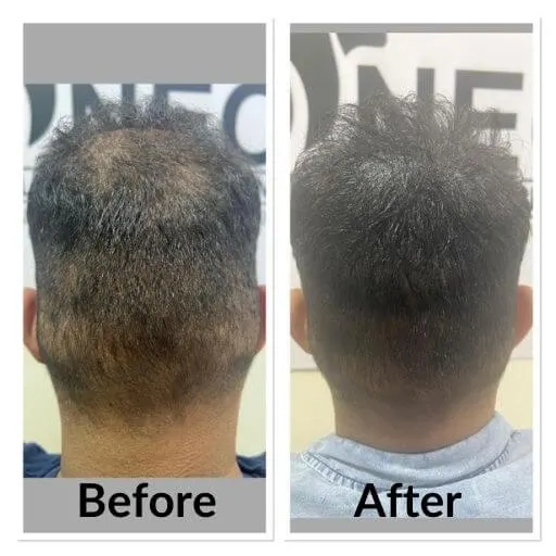 Before and after scalp micropigmentation at Neo Follicle.