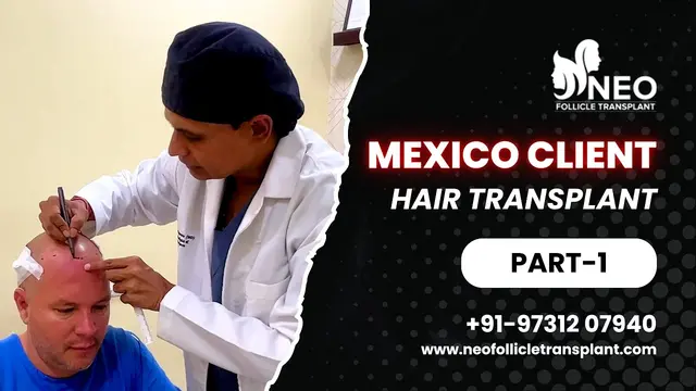 Best Hair Transplant Bangalore | Hair Transplant in Bangalore | best hair transplant clinic