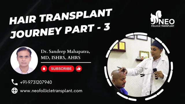 Hairline Marking | Hair Transplant in Bangalore | Best Hair Transplant Surgeon India