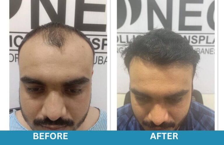 Neo Follicle Hair Transplant Bangalore | Marathahalli | Whitefield