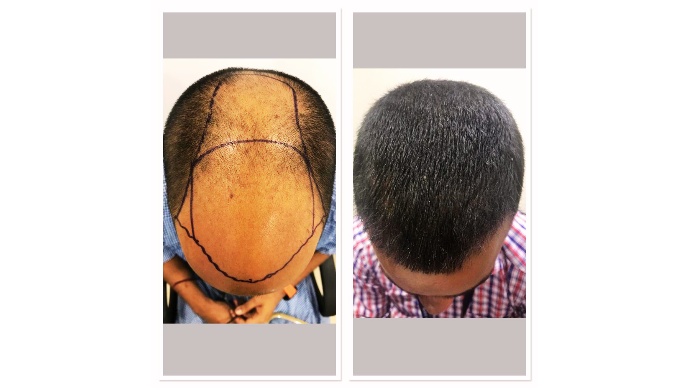 Why Clients Are Not Opting for FUT Hair Transplant Surgery Nowadays