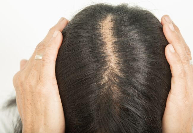 Woman with initial stage of baldness