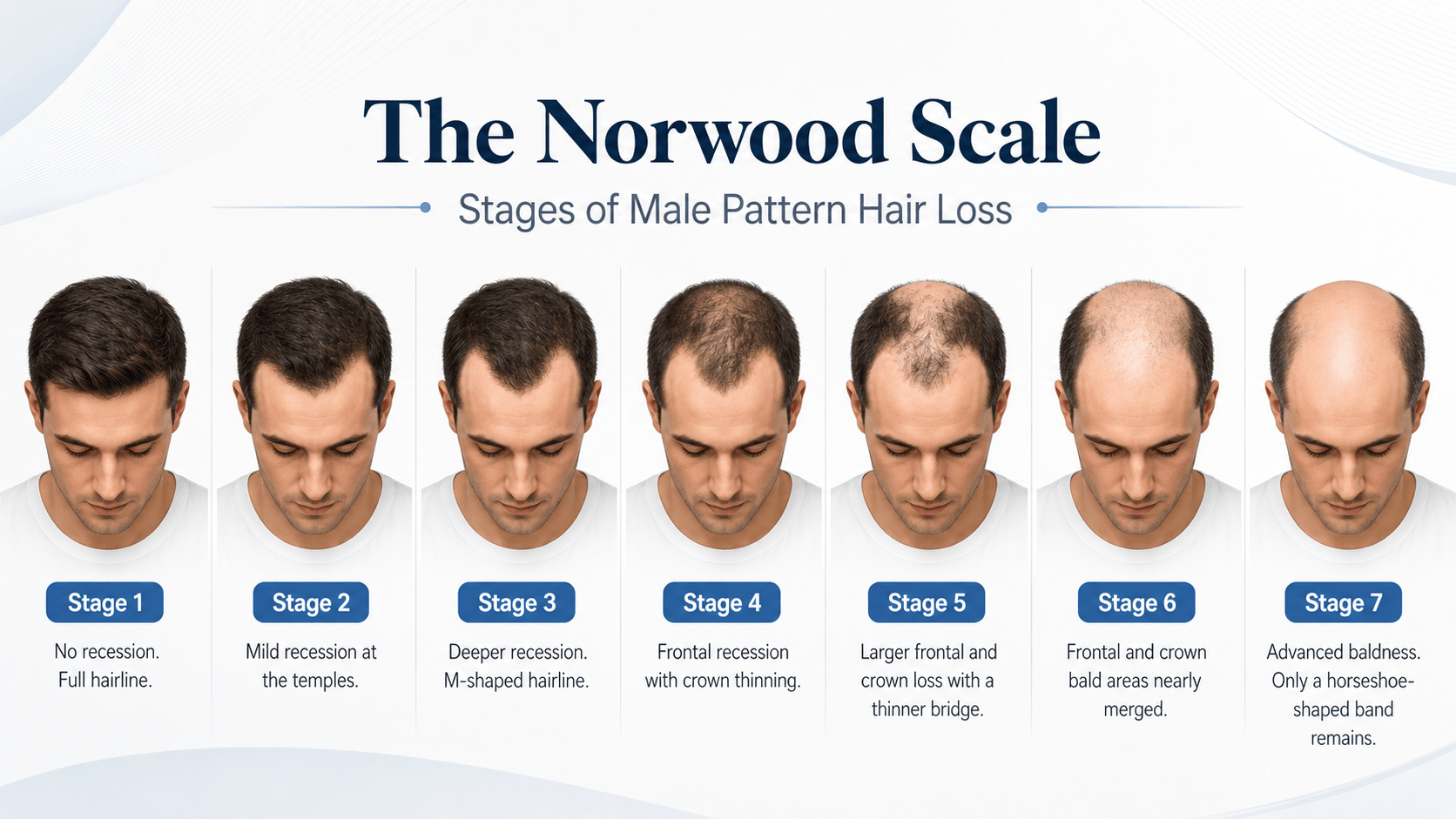 Norwood Scale Male Pattern Baldness